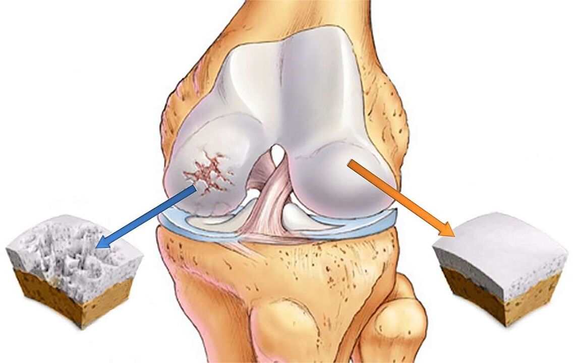 Destrución da cartilaxe da articulación do xeonllo con gonartrose
