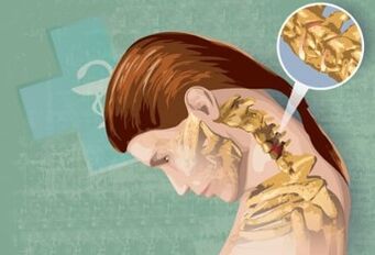 Síntomas reflexos da osteocondrose cervical