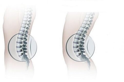 Columna vertebral normal e aumento da lordose lumbar