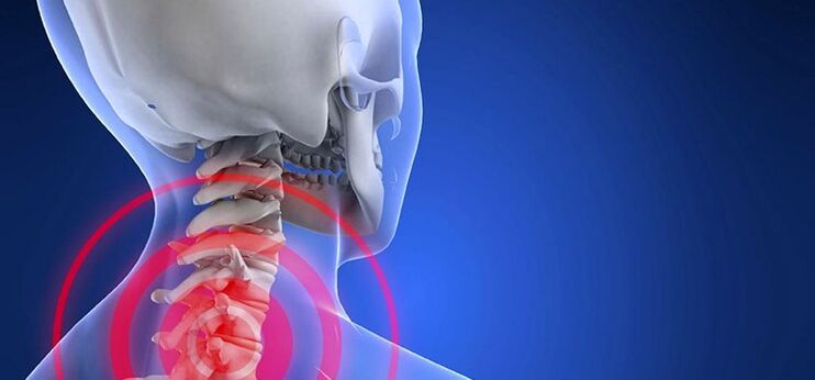 Osteocondrose da columna cervical