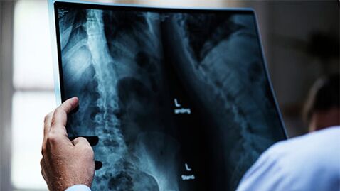 Radiografía da columna vertebral con osteocondrose